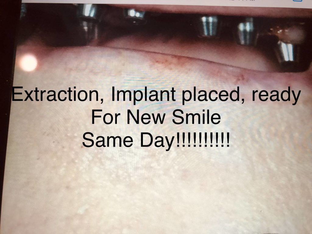 Implant Placed Case Study